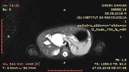 MRI cholangiopancreatography